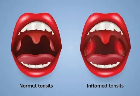 How to Manage Symptoms After Tonsillectomy