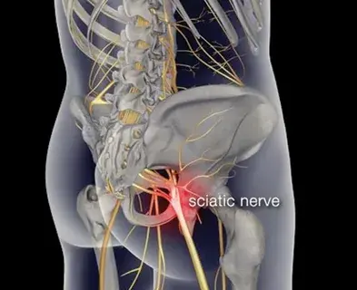 Say Goodbye to Sciatic Nerve Pain in Just 10 Minutes with This Natural Method